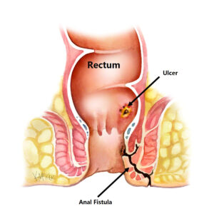 anal-fistula_e