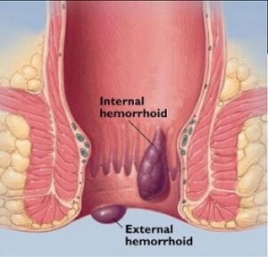 Piles / Haemorrhoids